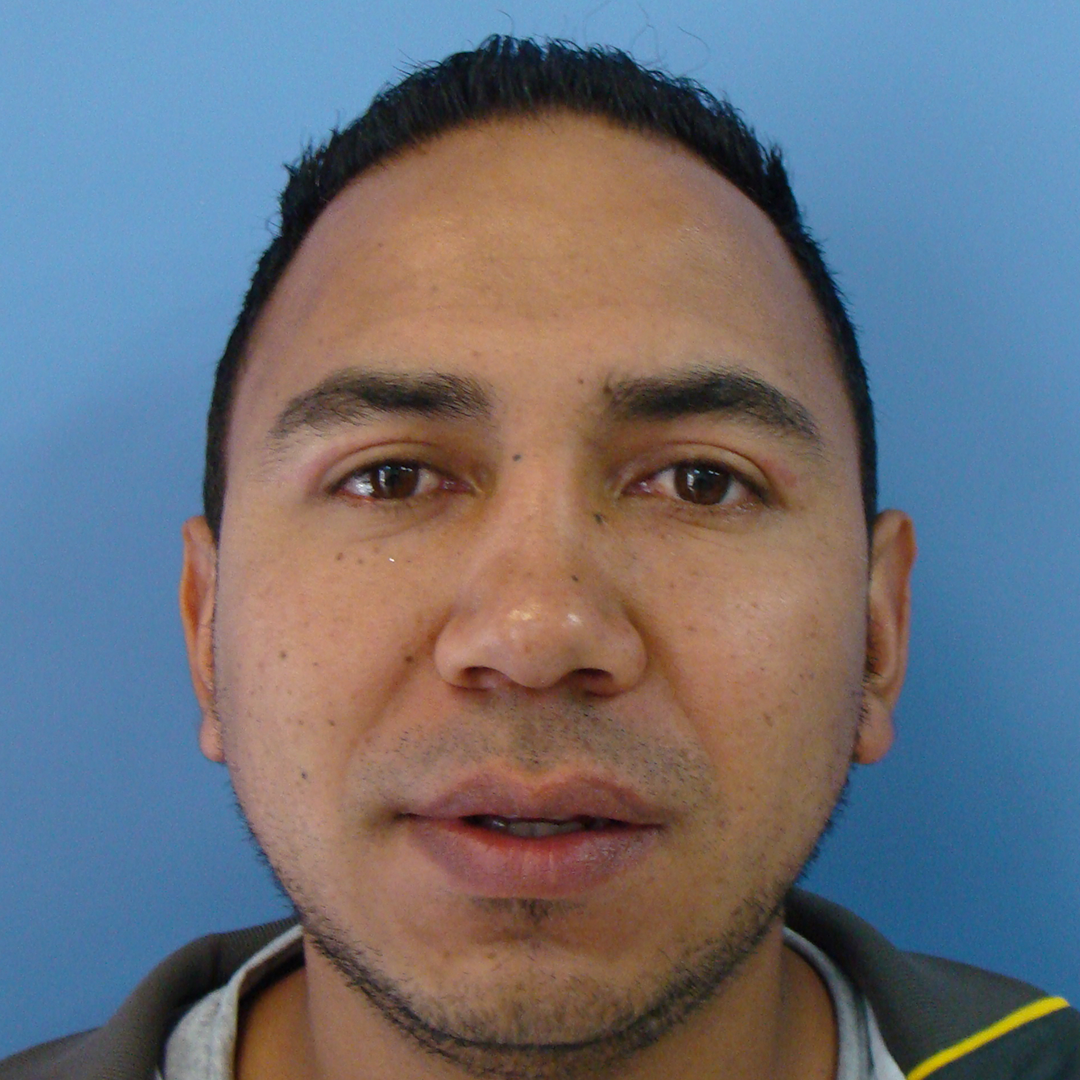 Celam-blefaroplastia-1-5-after