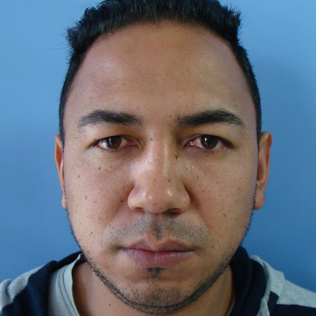 Celam-blefaroplastia-1-5-before