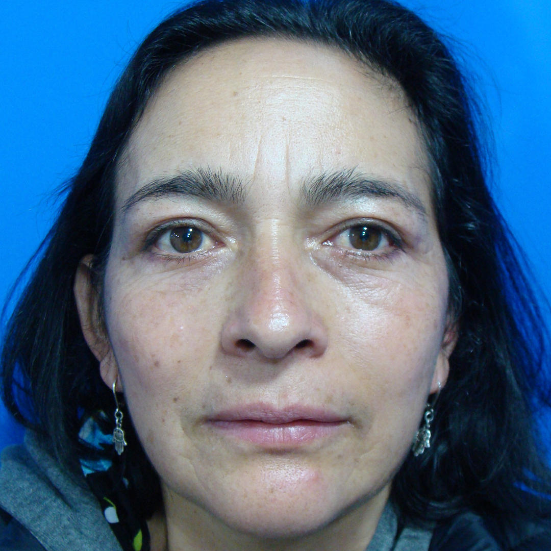 Celam-blefaroplastia-3-5-after