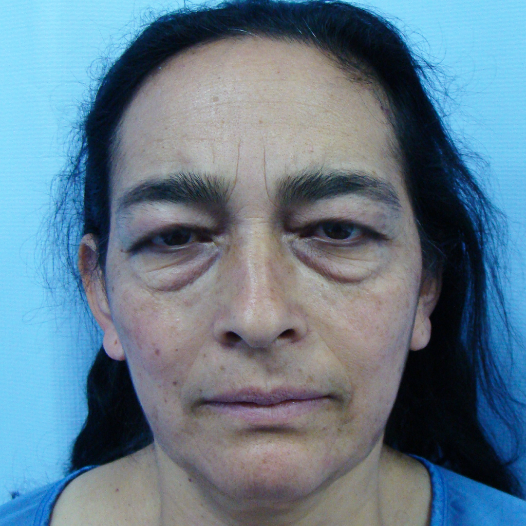 Celam-blefaroplastia-3-5-before