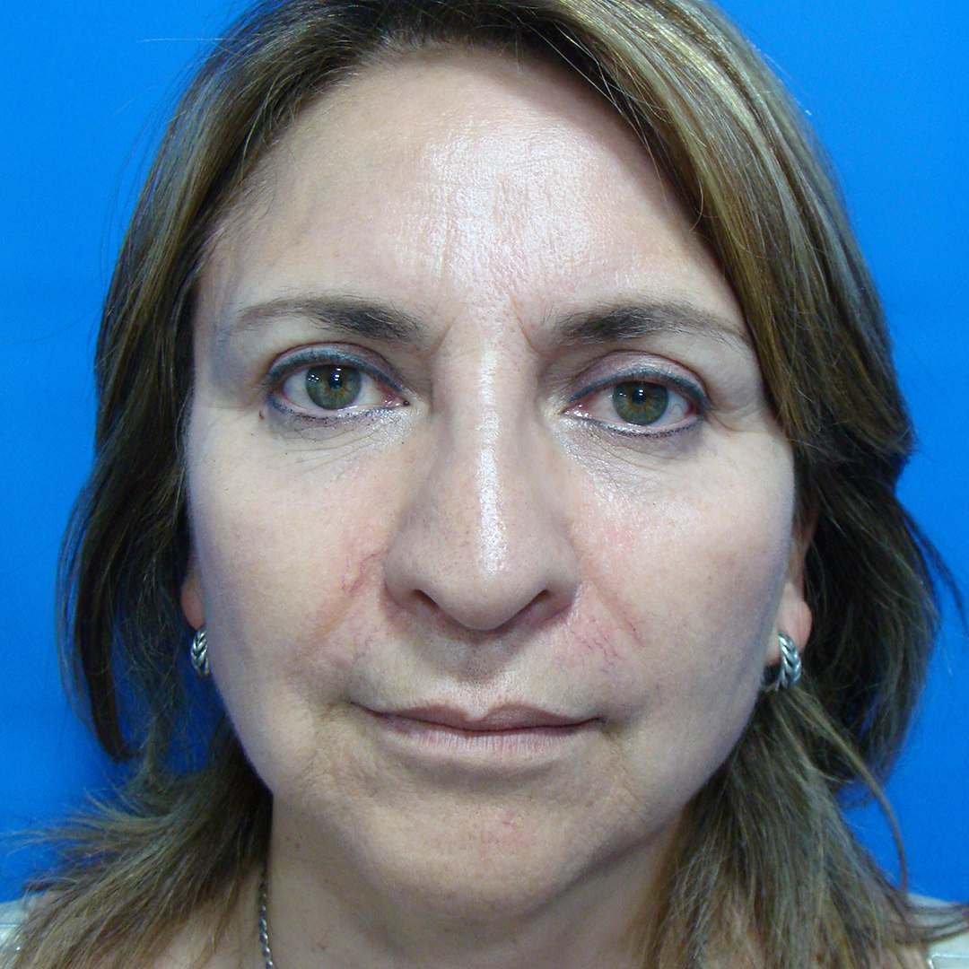 Celam-blefaroplastia-4-5-after