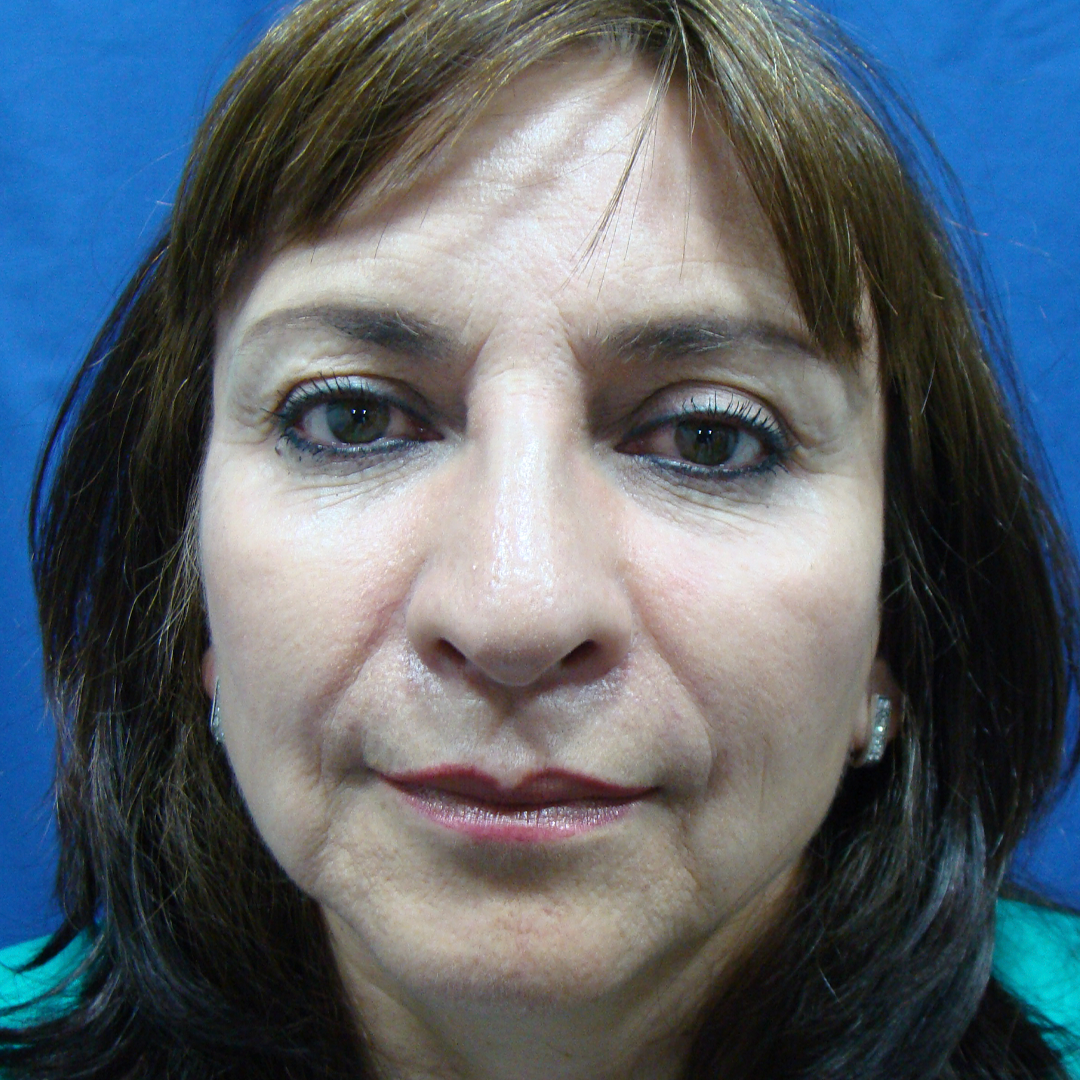 Celam-blefaroplastia-4-5-before