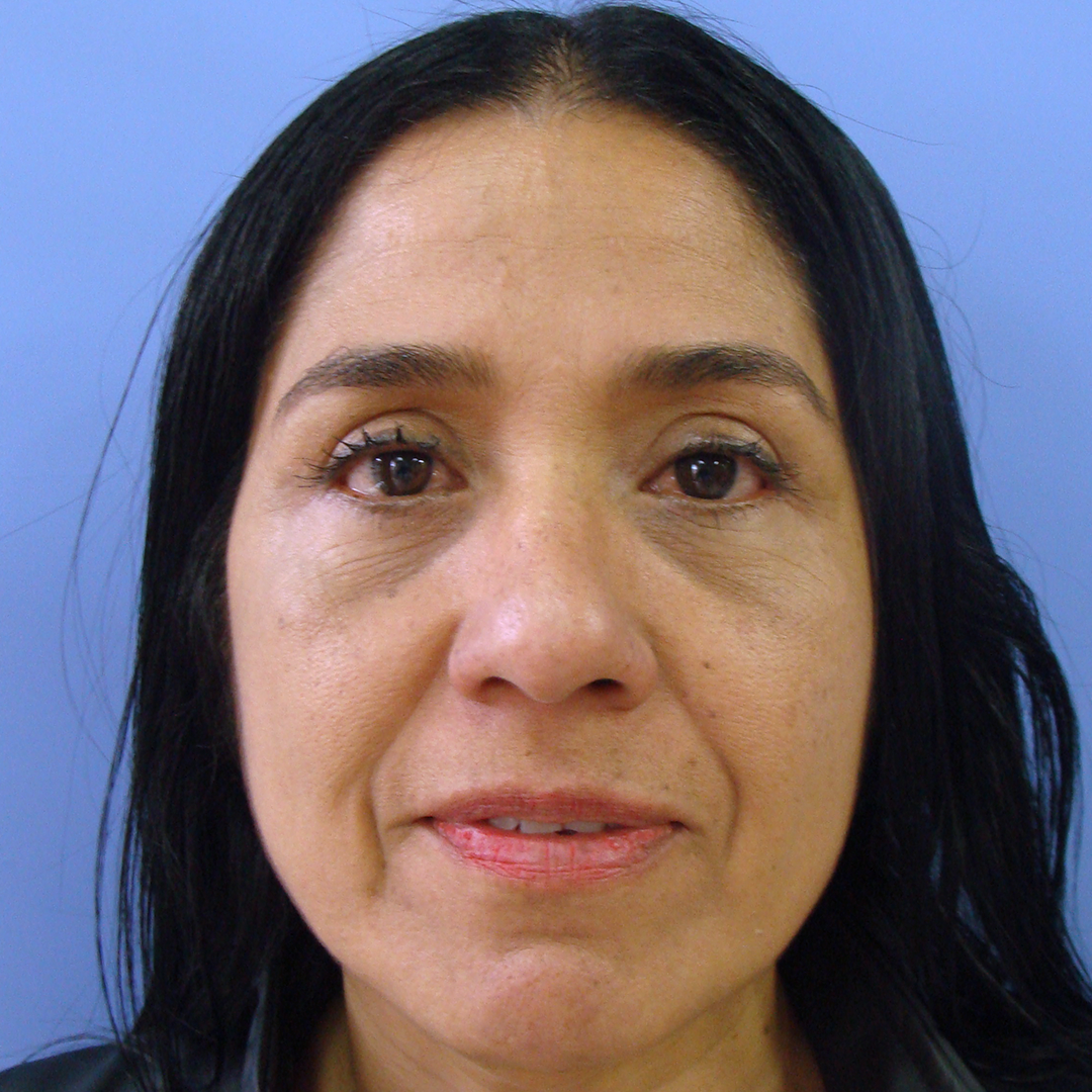 Celam-blefaroplastia-5-5-after