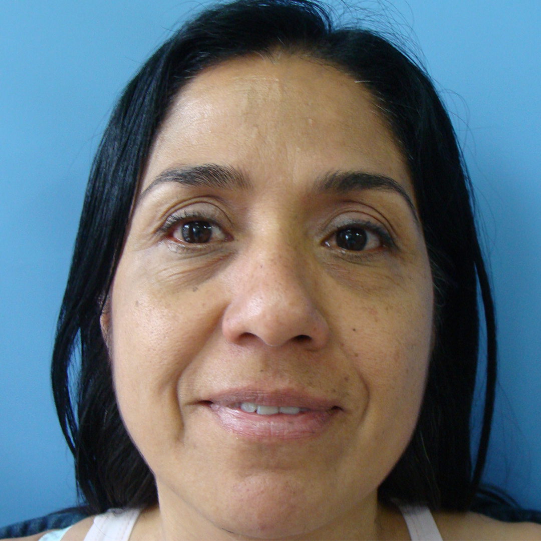 Celam-blefaroplastia-5-5-before